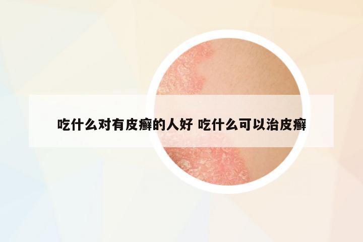 吃什么對(duì)有皮癬的人好 吃什么可以治皮癬