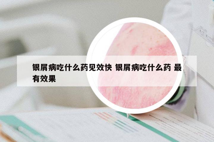 銀屑病吃什么藥見效快 銀屑病吃什么藥 最有效果