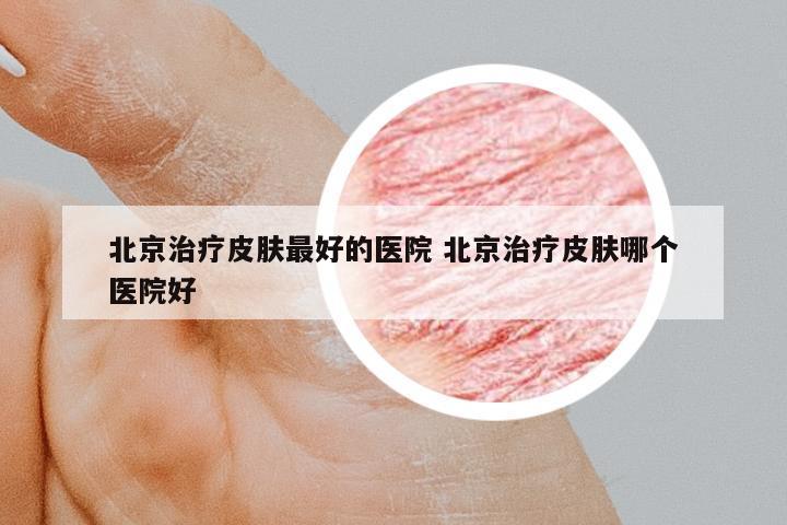 北京治療皮膚最好的醫(yī)院 北京治療皮膚哪個醫(yī)院好