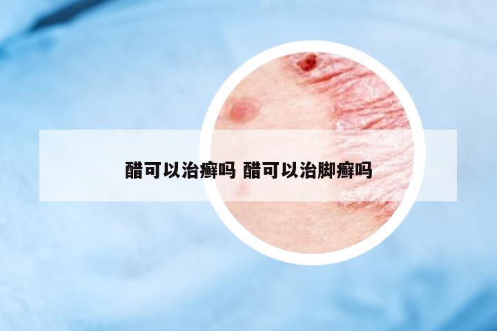 醋可以治癬嗎 醋可以治腳癬嗎