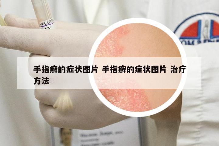 手指癬的癥狀圖片 手指癬的癥狀圖片 治療方法