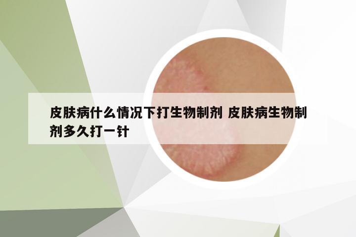 皮膚病什么情況下打生物制劑 皮膚病生物制劑多久打一針