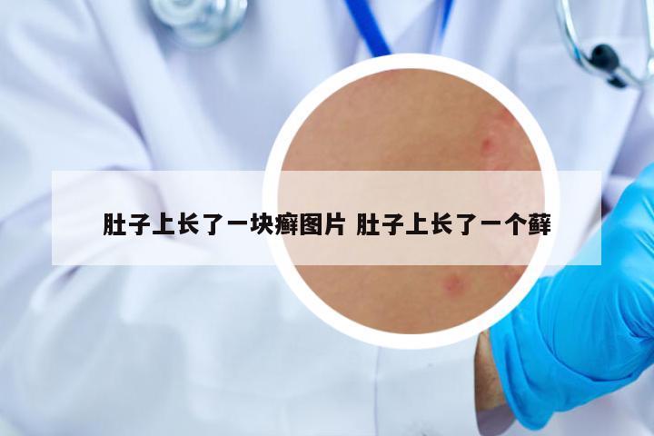 肚子上長(zhǎng)了一塊癬圖片 肚子上長(zhǎng)了一個(gè)蘚
