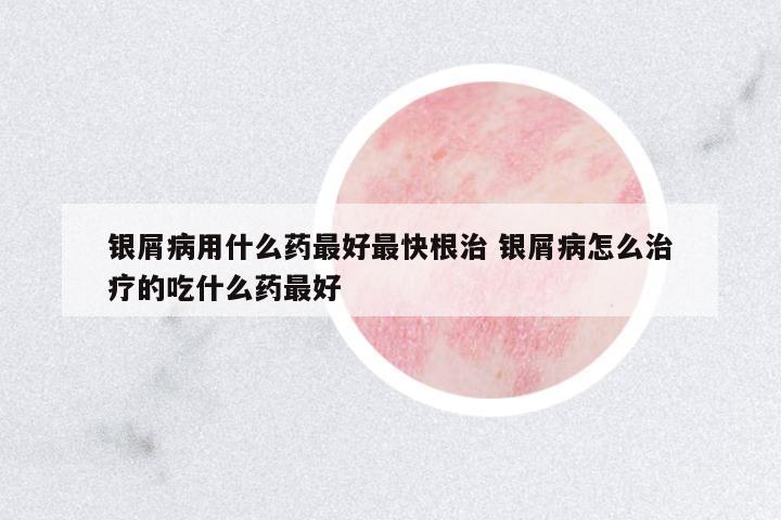 銀屑病用什么藥最好最快根治 銀屑病怎么治療的吃什么藥最好