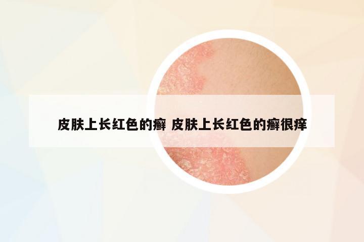 皮膚上長紅色的癬 皮膚上長紅色的癬很癢