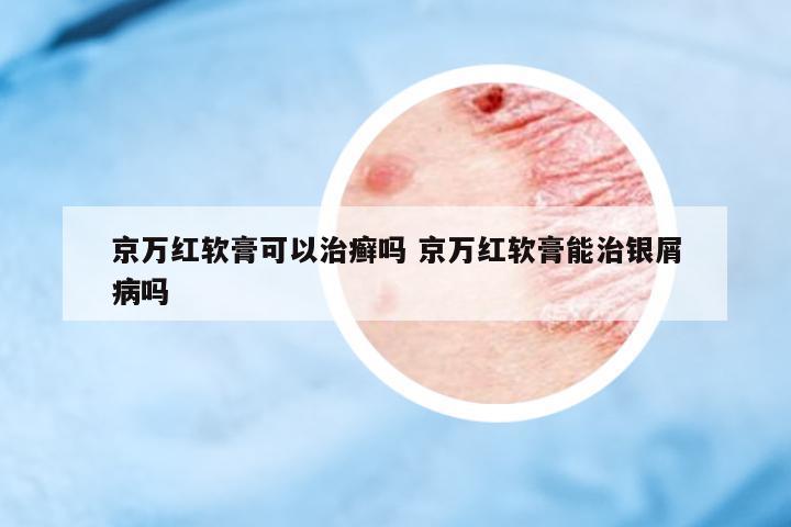 京萬紅軟膏可以治癬嗎 京萬紅軟膏能治銀屑病嗎