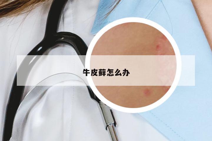 牛皮蘚怎么辦