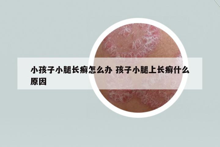 小孩子小腿長癬怎么辦 孩子小腿上長癬什么原因