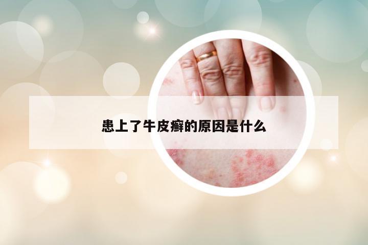 患上了牛皮癬的原因是什么