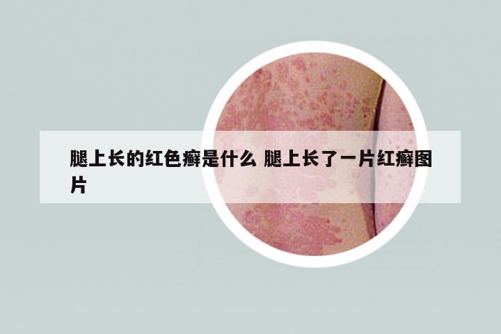 腿上長的紅色癬是什么 腿上長了一片紅癬圖片