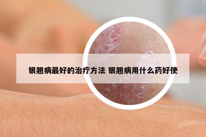 銀翹病最好的治療方法 銀翹病用什么藥好使