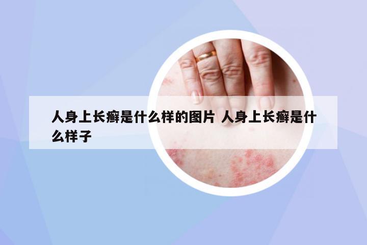 人身上長癬是什么樣的圖片 人身上長癬是什么樣子