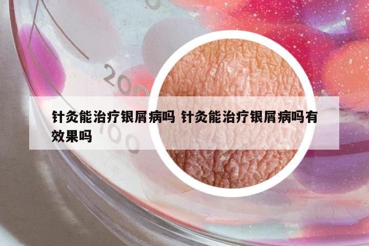 針灸能治療銀屑病嗎 針灸能治療銀屑病嗎有效果嗎