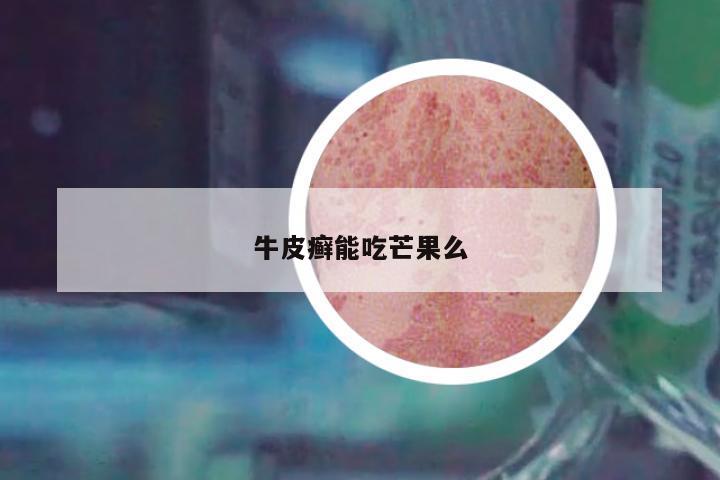 牛皮癬能吃芒果么