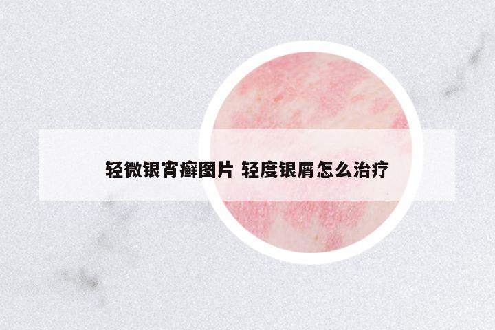 輕微銀宵癬圖片 輕度銀屑怎么治療