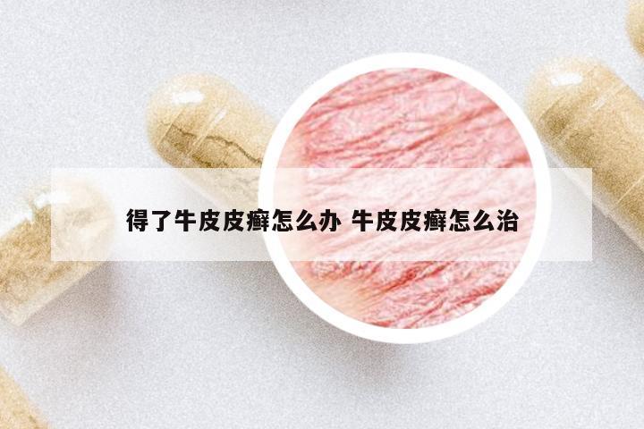 得了牛皮皮癬怎么辦 牛皮皮癬怎么治