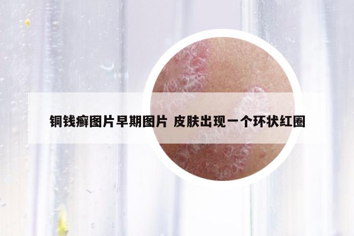 銅錢癬圖片早期圖片 皮膚出現(xiàn)一個(gè)環(huán)狀紅圈