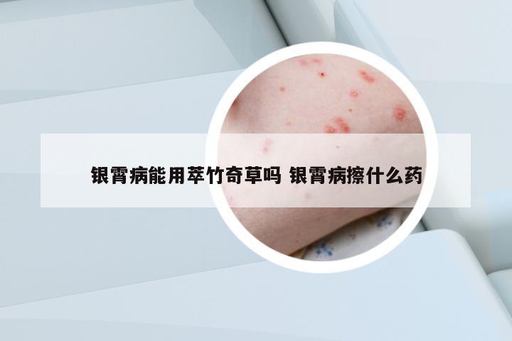 銀霄病能用萃竹奇草嗎 銀霄病擦什么藥