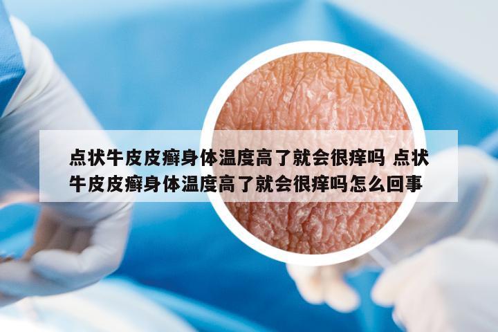 點狀牛皮皮癬身體溫度高了就會很癢嗎 點狀牛皮皮癬身體溫度高了就會很癢嗎怎么回事