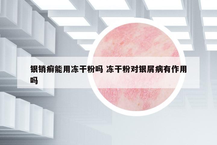 銀銷癬能用凍干粉嗎 凍干粉對銀屑病有作用嗎