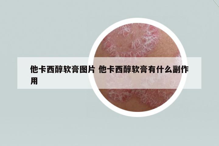 他卡西醇軟膏圖片 他卡西醇軟膏有什么副作用
