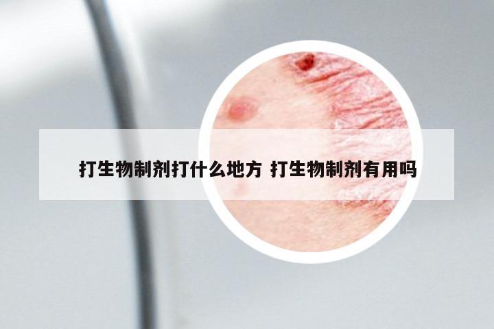打生物制劑打什么地方 打生物制劑有用嗎
