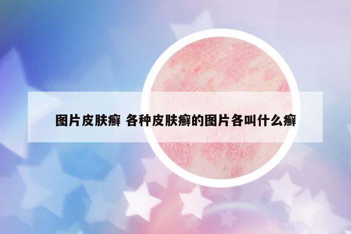 圖片皮膚癬 各種皮膚癬的圖片各叫什么癬