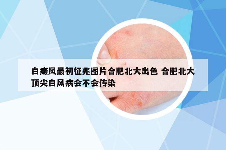 白癜風(fēng)最初征兆圖片合肥北大出色 合肥北大頂尖白風(fēng)病會(huì)不會(huì)傳染