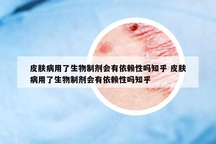 皮膚病用了生物制劑會有依賴性嗎知乎 皮膚病用了生物制劑會有依賴性嗎知乎