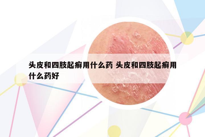 頭皮和四肢起癬用什么藥 頭皮和四肢起癬用什么藥好