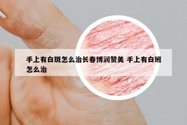 手上有白斑怎么治長春博潤贊美 手上有白班怎么治