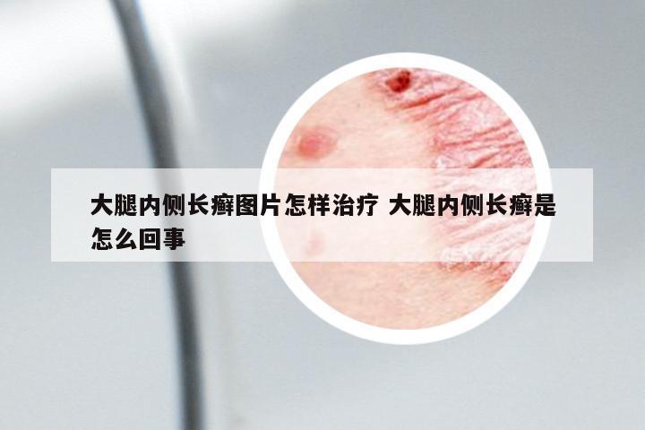 大腿內(nèi)側(cè)長癬圖片怎樣治療 大腿內(nèi)側(cè)長癬是怎么回事