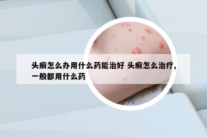 頭癬怎么辦用什么藥能治好 頭癬怎么治療,一般都用什么藥