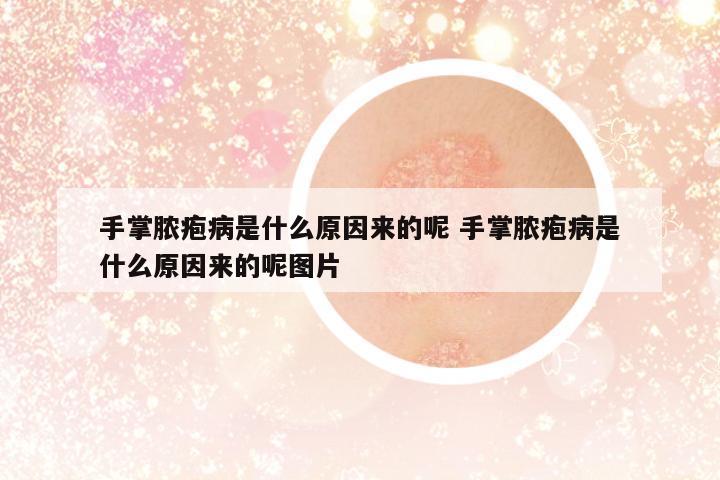 手掌膿皰病是什么原因來的呢 手掌膿皰病是什么原因來的呢圖片