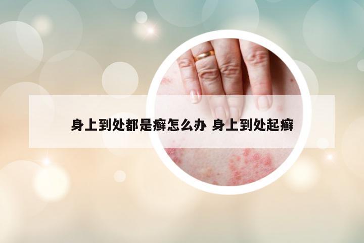 身上到處都是癬怎么辦 身上到處起癬