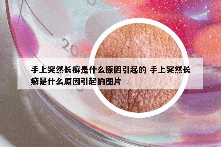 手上突然長(zhǎng)癬是什么原因引起的 手上突然長(zhǎng)癬是什么原因引起的圖片