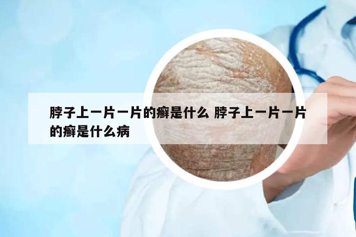 脖子上一片一片的癬是什么 脖子上一片一片的癬是什么病