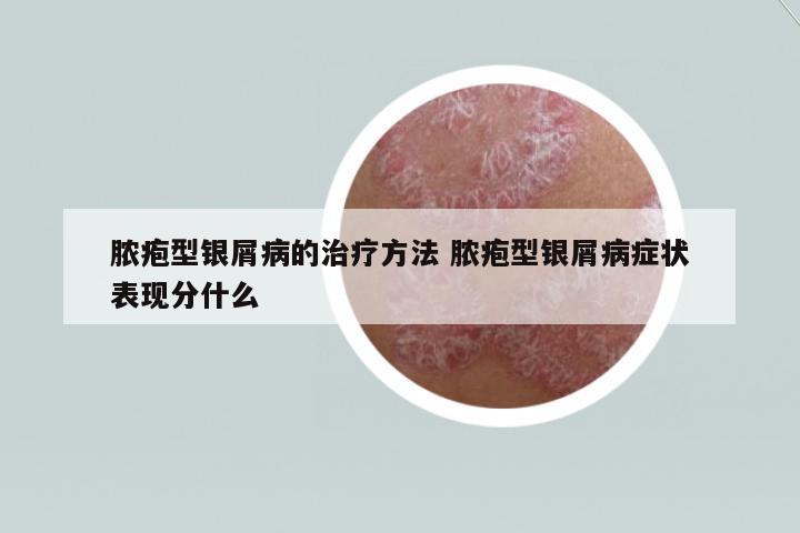 膿皰型銀屑病的治療方法 膿皰型銀屑病癥狀表現(xiàn)分什么