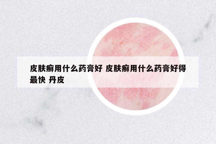 皮膚癬用什么藥膏好 皮膚癬用什么藥膏好得最快 丹皮
