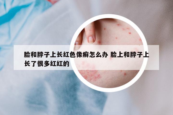 臉和脖子上長紅色像癬怎么辦 臉上和脖子上長了很多紅紅的