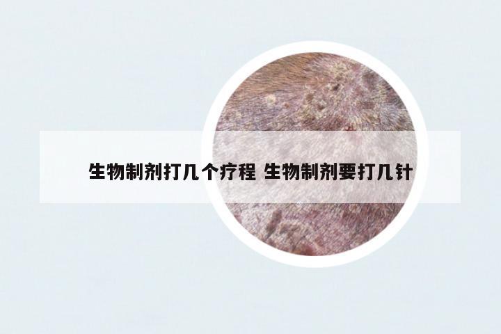 生物制劑打幾個(gè)療程 生物制劑要打幾針