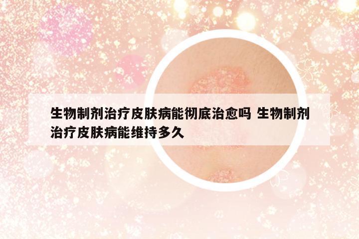 生物制劑治療皮膚病能徹底治愈嗎 生物制劑治療皮膚病能維持多久