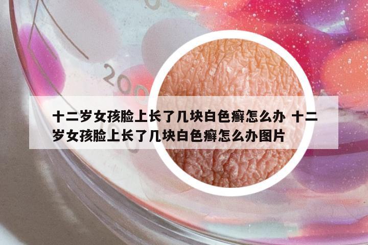 十二歲女孩臉上長了幾塊白色癬怎么辦 十二歲女孩臉上長了幾塊白色癬怎么辦圖片