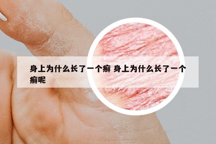 身上為什么長(zhǎng)了一個(gè)癬 身上為什么長(zhǎng)了一個(gè)癬呢