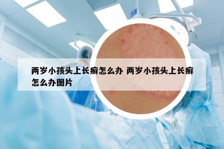 兩歲小孩頭上長癬怎么辦 兩歲小孩頭上長癬怎么辦圖片
