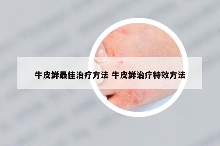 牛皮鮮最佳治療方法 牛皮鮮治療特效方法