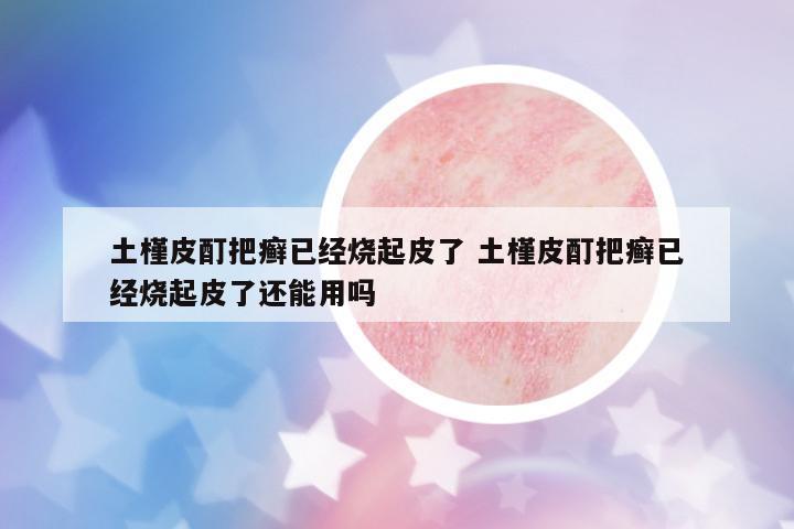 土槿皮酊把癬已經(jīng)燒起皮了 土槿皮酊把癬已經(jīng)燒起皮了還能用嗎