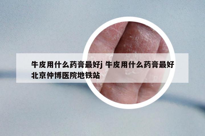 牛皮用什么藥膏最好j 牛皮用什么藥膏最好北京仲博醫(yī)院地鐵站