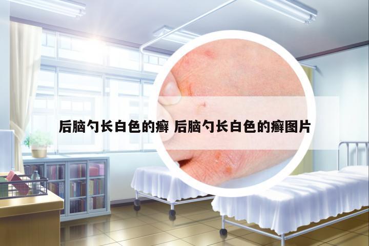 后腦勺長白色的癬 后腦勺長白色的癬圖片