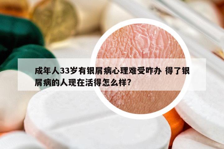成年人33歲有銀屑病心理難受咋辦 得了銀屑病的人現(xiàn)在活得怎么樣?